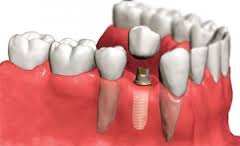implantologia dentale torino
