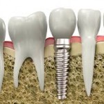 Clinica specializzata in implantologia dentale